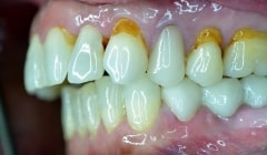Side view of smile with yellowing at the gum line