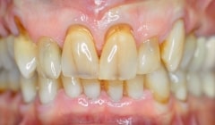 Severely yellowed and damaged teeth before restorative dentistry