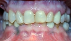 Severely discolored smile before teeth whitening