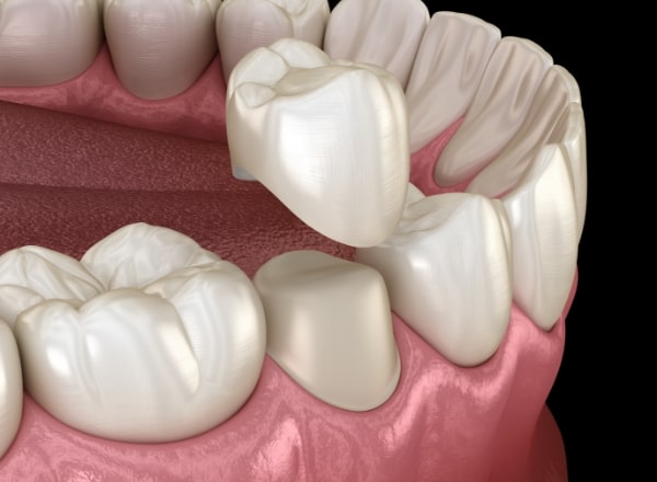 Animated smile during dental crown placement