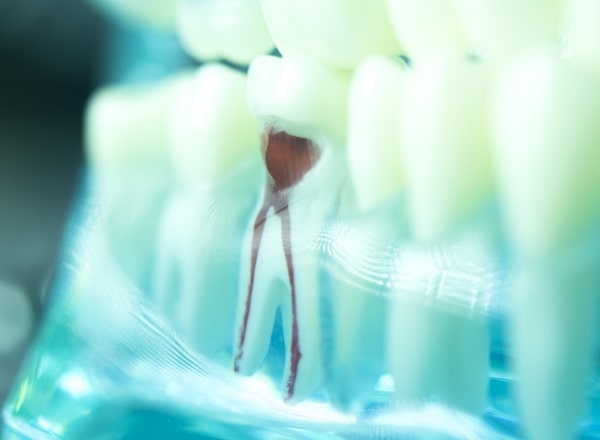 Model tooth after root canal therapy