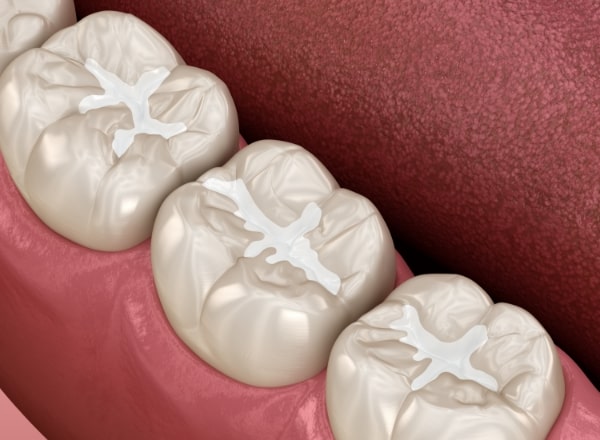 Animated row of teeth with dental sealants