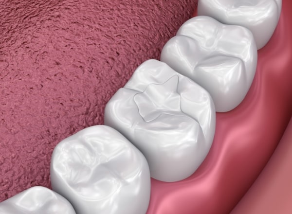 Animated smile with dental sealants