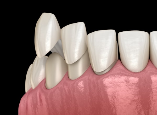 Animated smile during dental bonding treatment