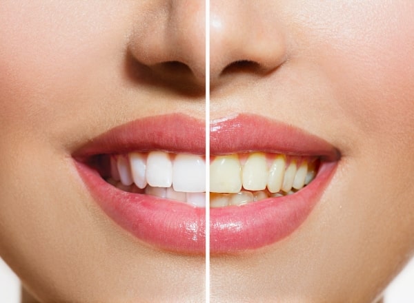 Smile before and after teeth whitening