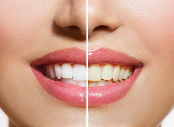 Smile before and after teeth whitening