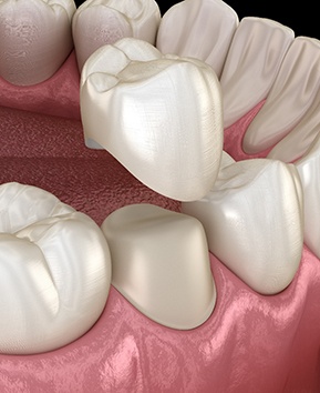 A digital image of a dental crown for a tooth on the lower arch 