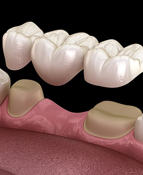 A digital image of a dental bridge situated on the lower arch
