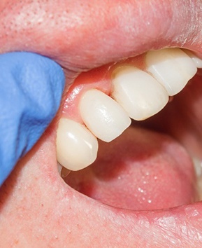 A side-by-side view of a person’s decayed tooth and how their smile looks after a dental crown is put into place