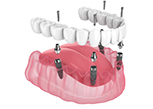 Illustration of All-on-4 dentures