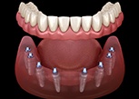 A 3D illustration of implant dentures