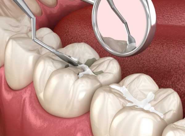 Animated tooth colored filling placement process