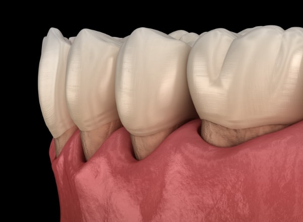 Animated smile with receding gums before periodontal therapy