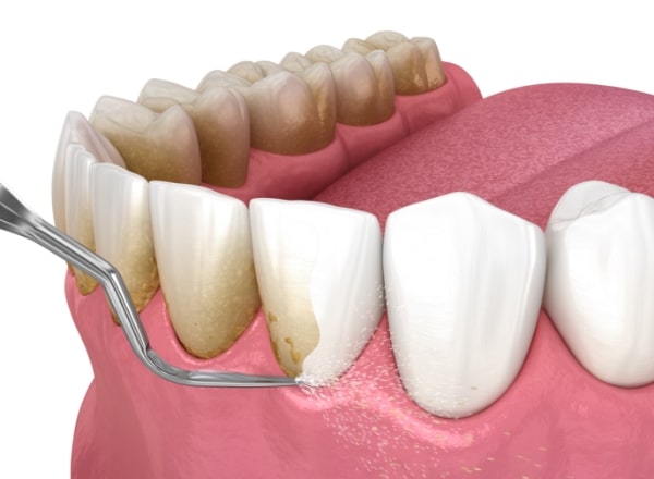 Animated smile during periodontal therapy to remove plaque