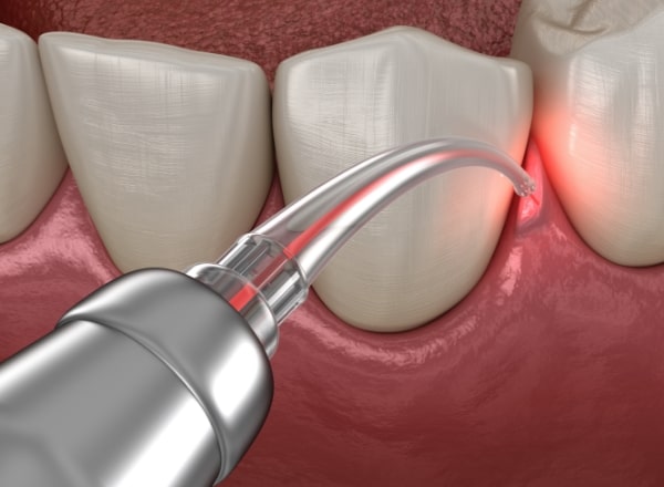 Animated smile during scaling and root planing treatment