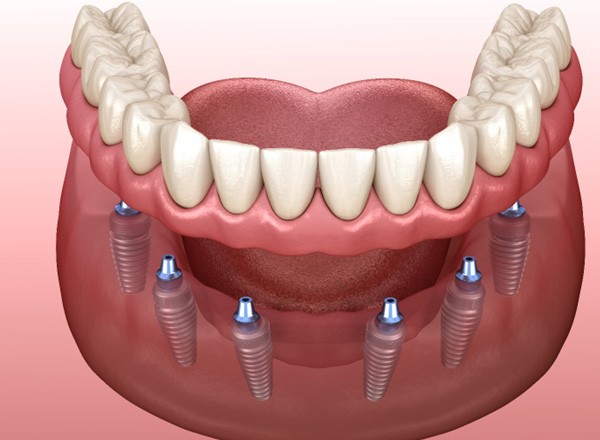 Digital illustration of implant denture