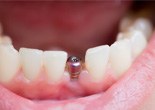 closeup of person smiling with dental implant in Phoenix