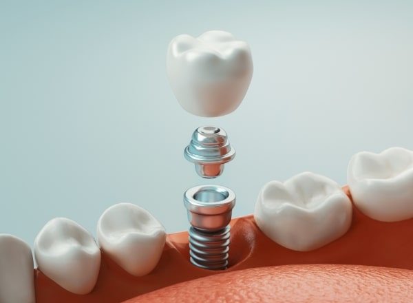 Animated smile showing dental implant supported dental crown placement