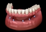 Animated smile during dental implant supported denture placment