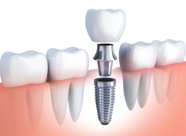 Animated dental implant supported dental crown process