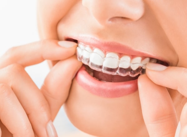 Invisalign Phoenix, AZ, Clear Braces