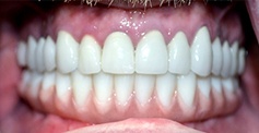 Smile after bottom teeth are replaced