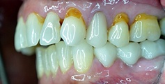 Side view of smile with yellow discoloration at the gum line