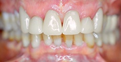 Flawless healthy smile after cosmetic dentistry