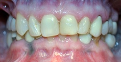 Discolored smile before cosmetic dentistry
