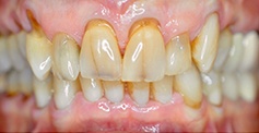 Severely yellowed and decayed smile before cosmetic dentistry