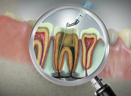 Root canals can range in price from patient to patient