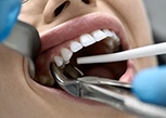 It may be cheaper up front to extract an infected tooth; however, this can cost you more in the long run