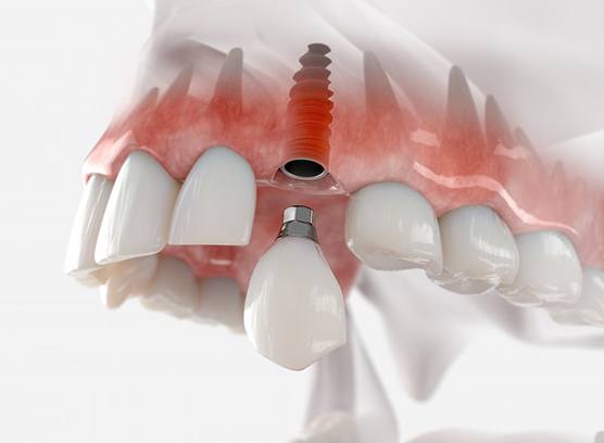 a 3D illustration of a dental implant in the jawbone