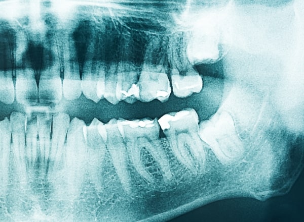 Digital dental x-rays