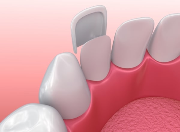 diagram of veneer being placed on tooth 