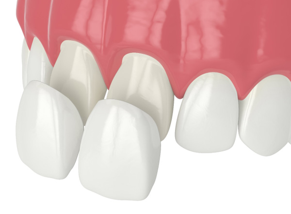 Illustration of veneers being placed on front teeth