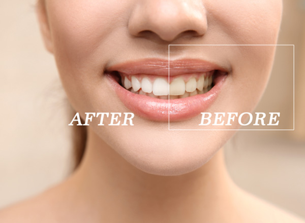 Closeup of patient's smile before and after teeth whitening