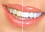 Closeup of a smile that’s half whitened and has sparkly lip gloss
