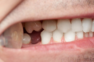 Teeth with gap of missing tooth close-up