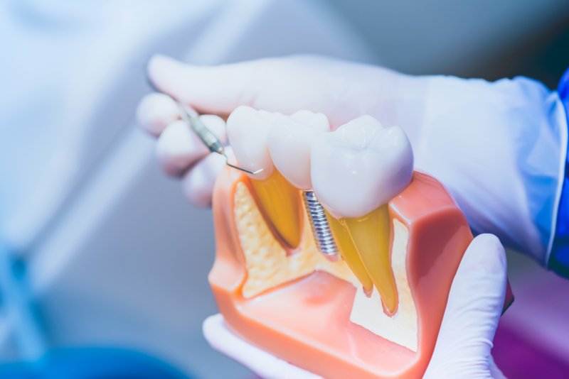 Dental implants in North Phoenix