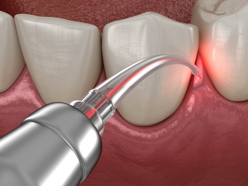 Close-up of dental laser being used between teeth