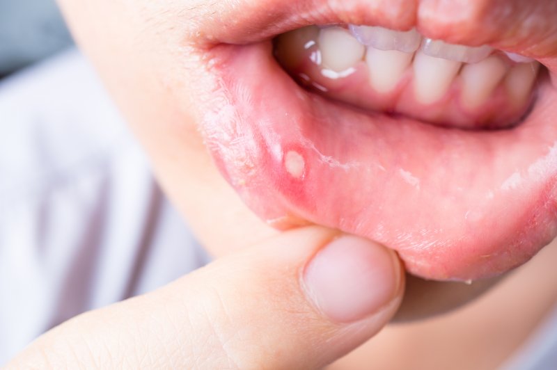 Dental patient with mouth sores