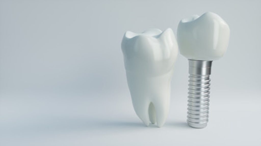 Image of dental implants on white background.