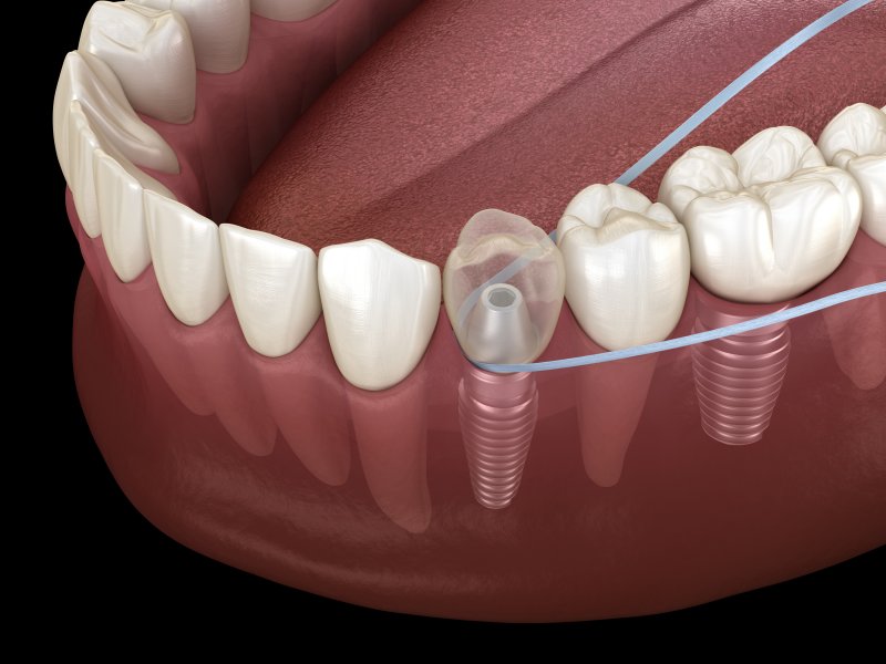 An illustration of someone flossing dental implants in Phoenix